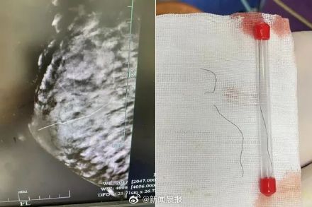 宝妈用猫咪胡须通乳出意外,医生大海捞针发现已经缩进乳头2厘米 宝妈用猫咪胡须通乳出意外,医生大海捞针发现已经缩进乳头2厘米