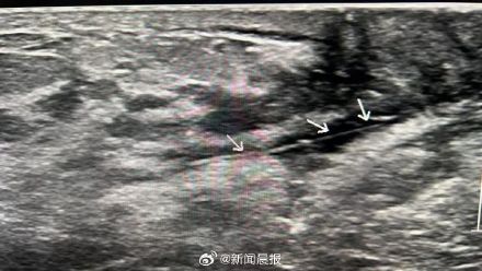 宝妈用猫咪胡须通乳出意外,医生大海捞针发现已经缩进乳头2厘米 宝妈用猫咪胡须通乳出意外,医生大海捞针发现已经缩进乳头2厘米