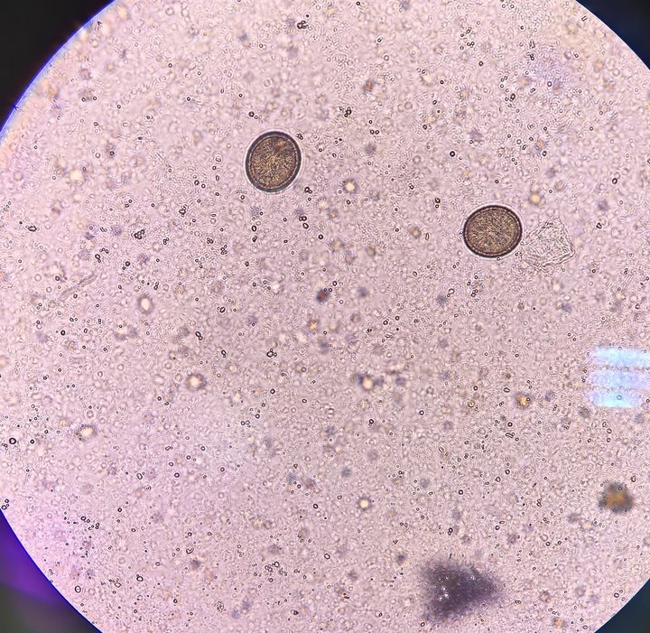 吓坏了!小伙体内藏2.73米长的虫 吓坏了!小伙体内藏2.73米长的虫