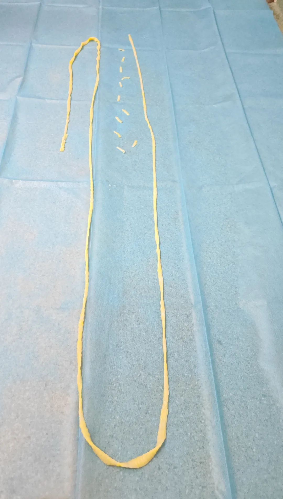 吓坏了!小伙体内藏2.73米长的虫 吓坏了!小伙体内藏2.73米长的虫