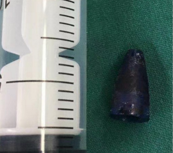 9岁男孩肺部感染咳嗽数月，医生竟在肺里发现……好多孩子都有这个习惯！