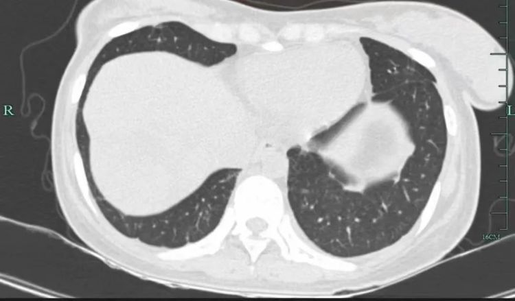年仅30岁,肺部犹如“满天星”!几个月后消失了 年仅30岁,肺部犹如“满天星”!几个月后消失了