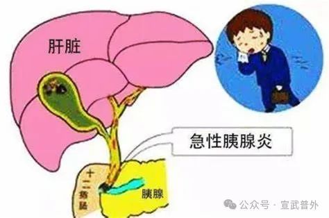 小心“胰腺发脾气”！