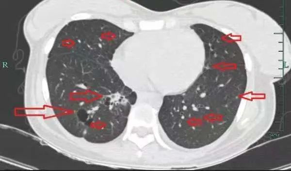 年仅30岁,肺部犹如“满天星”!几个月后消失了 年仅30岁,肺部犹如“满天星”!几个月后消失了