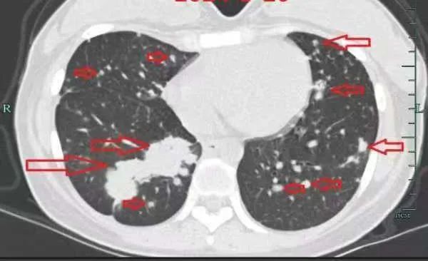 年仅30岁,肺部犹如“满天星”!几个月后消失了 年仅30岁,肺部犹如“满天星”!几个月后消失了