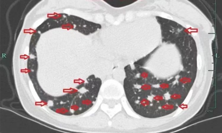年仅30岁,肺部犹如“满天星”!几个月后消失了 年仅30岁,肺部犹如“满天星”!几个月后消失了