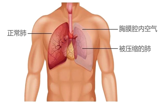 一口气做20个俯卧撑后“肺炸了”？咋回事？