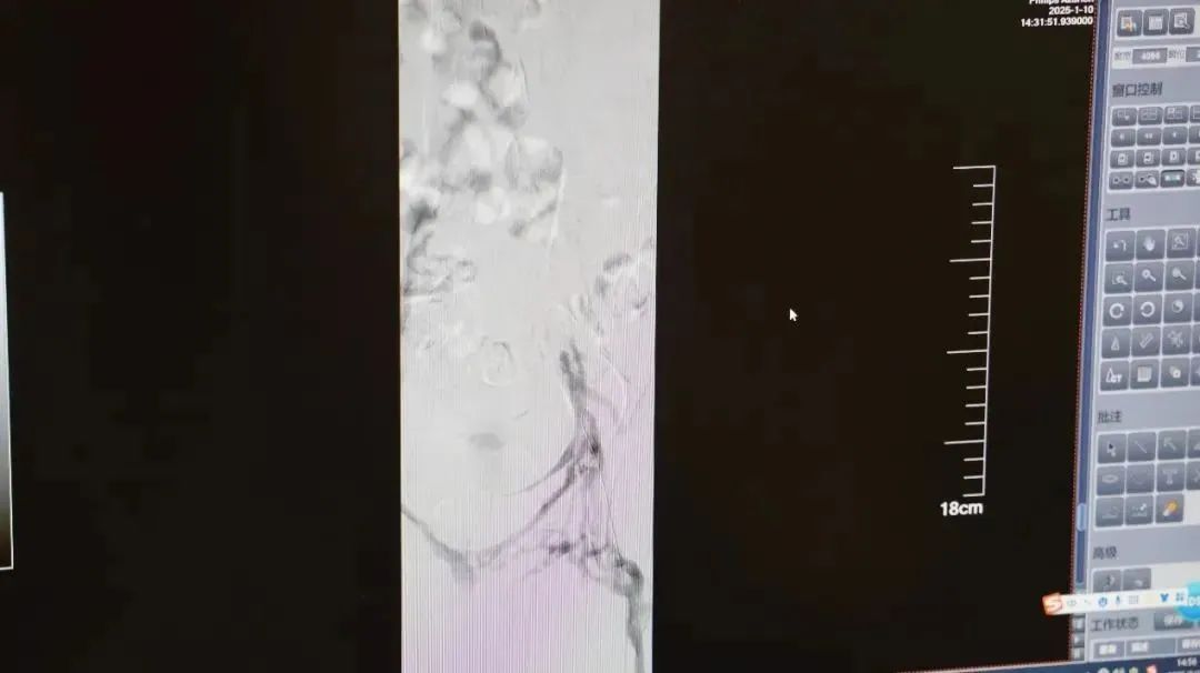 23岁小伙险些截肢，接连十余人确诊！这个习惯很多人都有