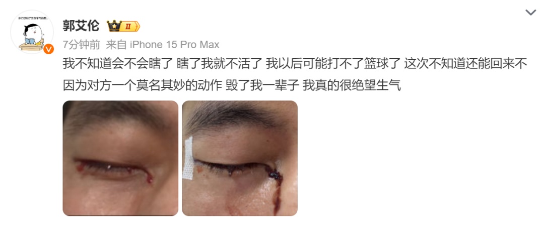 郭艾伦训练突发意外,眼睛流血缝了40多针,广州龙狮发布伤情报告! 郭艾伦训练突发意外,眼睛流血缝了40多针,广州龙狮发布伤情报告!