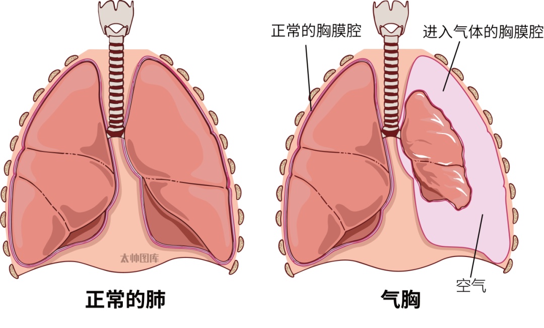 一口气做了20个，肺缩到仅剩三分之一！注意：别再这样干了