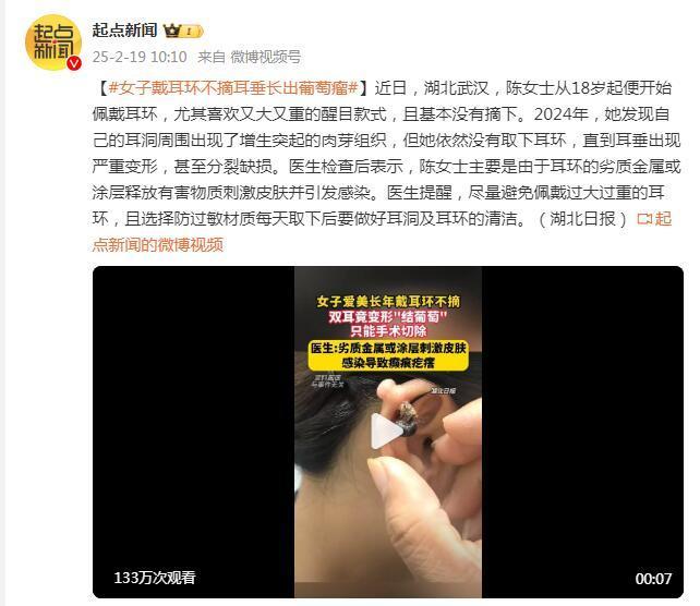 女子长年不摘耳环双耳“结葡萄” 细菌聚集耳垂严重变形