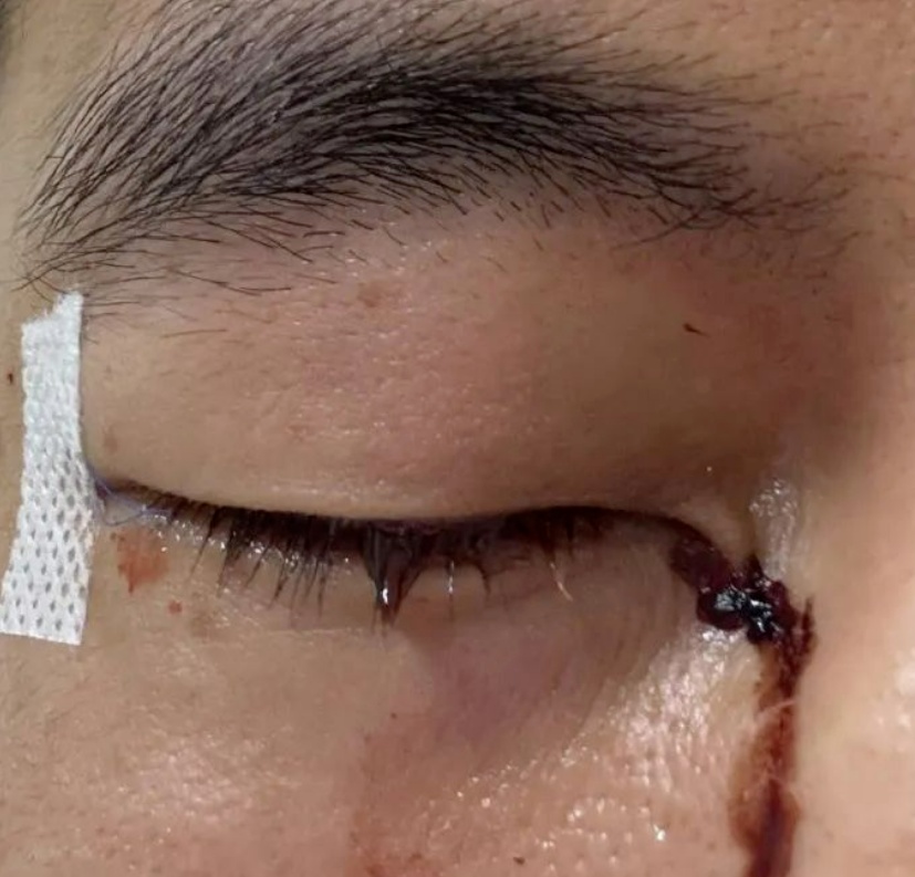 突然受伤结膜破碎！郭艾伦：以后可能打不了篮球了……