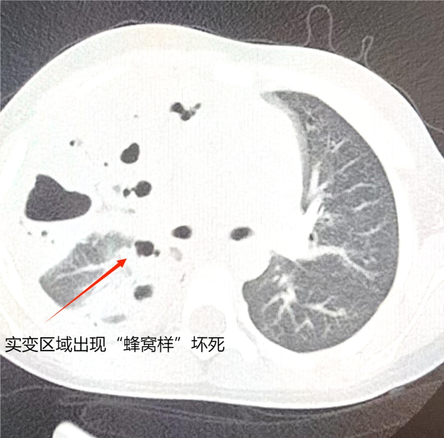 抗生素不起效，7岁男孩右肺成了“蜂窝煤”！