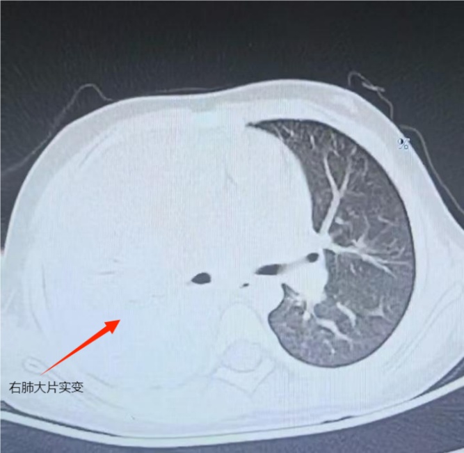 抗生素不起效，7岁男孩右肺成了“蜂窝煤”！