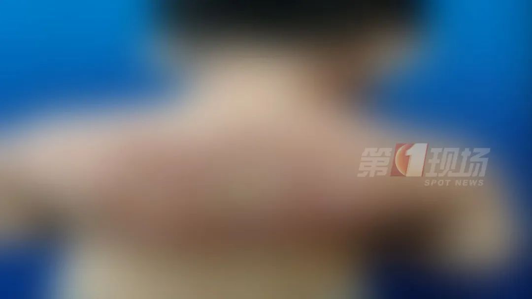 子母俩起皮疹泰半年，竟是衣裳“没洗对”？！
