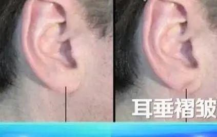 血管不好，从脸上能看出来！警惕→