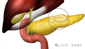 得了胰腺囊肿怎么办？