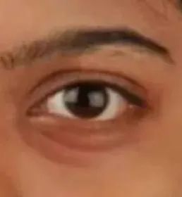 如何避免哪吒同款黑眼圈？