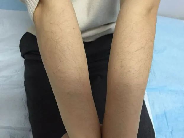 女孩一个假期实现“逆袭”，返工后却成“原始人”！医生提醒：千万要注意