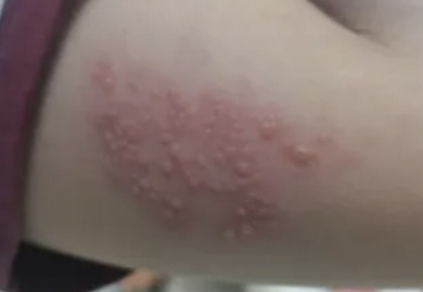 一旦感染终身携带，有人疼了40年！到底要怎么防？