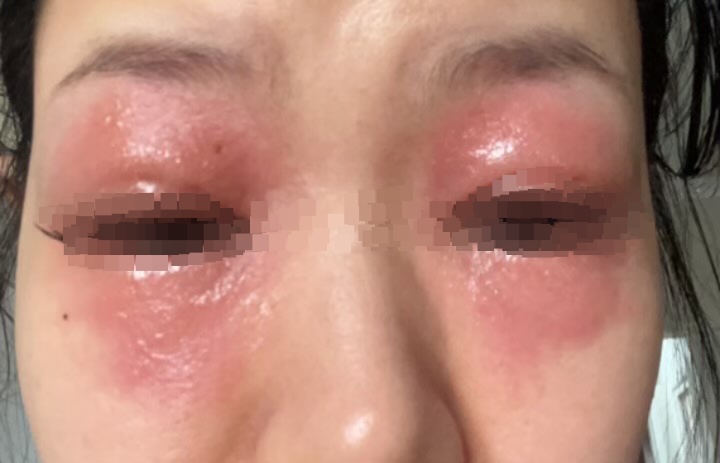 女子种睫毛后双眼肿得睁不开!医生提醒:这些人需慎重 女子种睫毛后双眼肿得睁不开!医生提醒:这些人需慎重