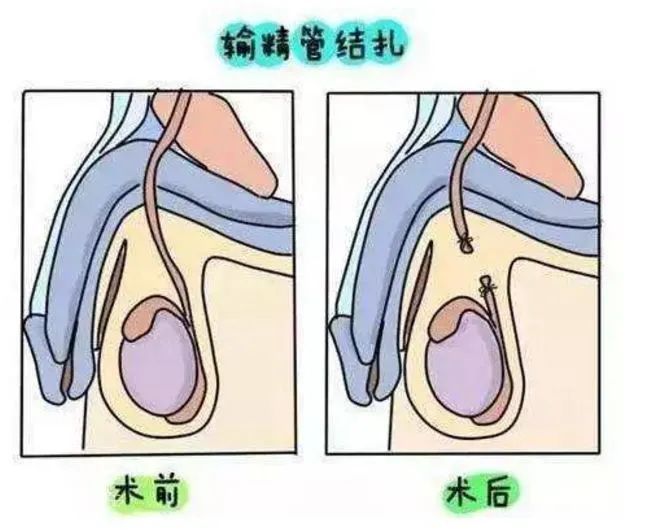 男子结扎3个月后老婆又怀孕了！医院赔偿……