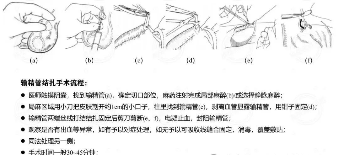 男子结扎3个月后，妻子怀孕了！两人傻眼…此前已怀孕8次生下3孩