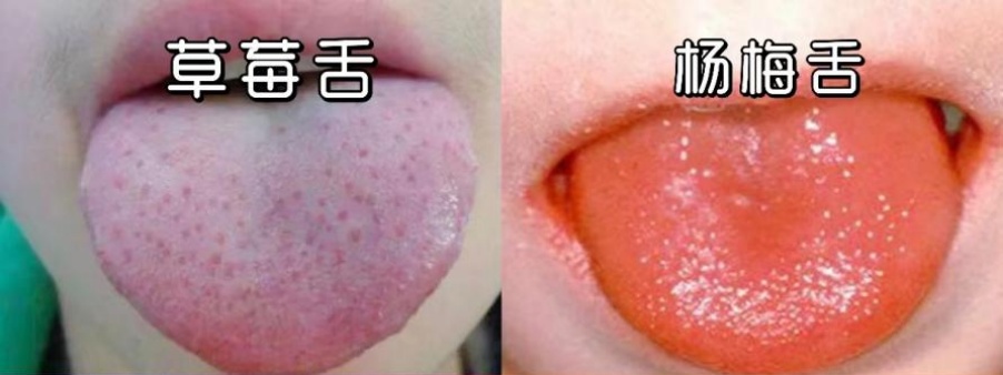 不是流感，暂无疫苗可预防！广东1月确诊2328例，有娃刚开学就请假10天