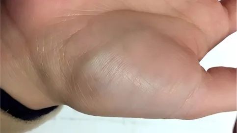 警惕！手腕、脚腕冒青筋？小心这些疾病→