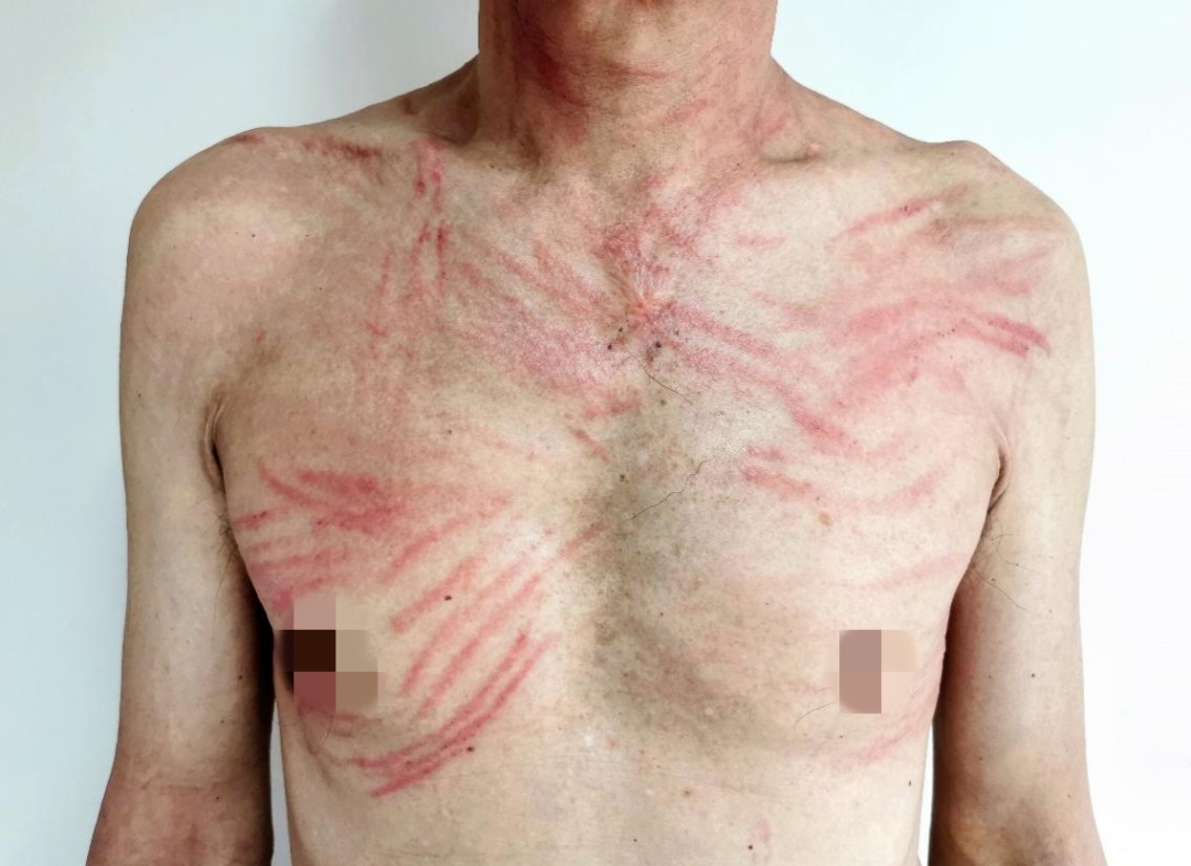 吓人！女子双腿像被“鞭打”，瘙痒难忍！没想到竟是家常菜惹祸