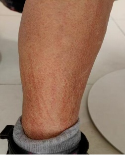 吓人！女子双腿像被“鞭打”，瘙痒难忍！没想到竟是家常菜惹祸