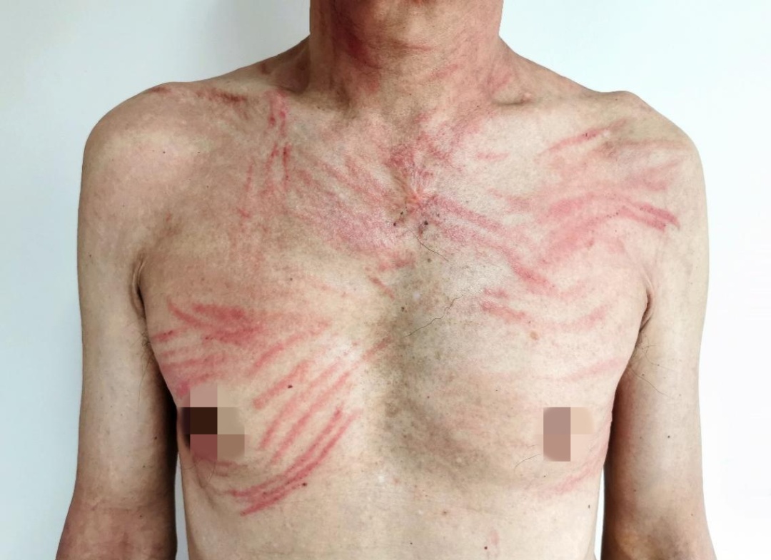 吓人!女子双腿像被“鞭打”,瘙痒难忍……竟是因为它 吓人!女子双腿像被“鞭打”,瘙痒难忍……竟是因为它