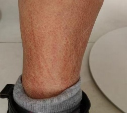 吓人!女子双腿像被“鞭打”,瘙痒难忍……竟是因为它 吓人!女子双腿像被“鞭打”,瘙痒难忍……竟是因为它