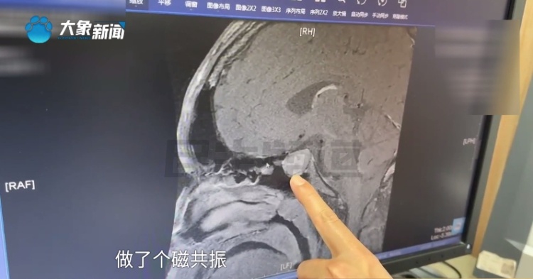 16岁男孩身高疯长到199cm！一查懵了……很多家长有误区