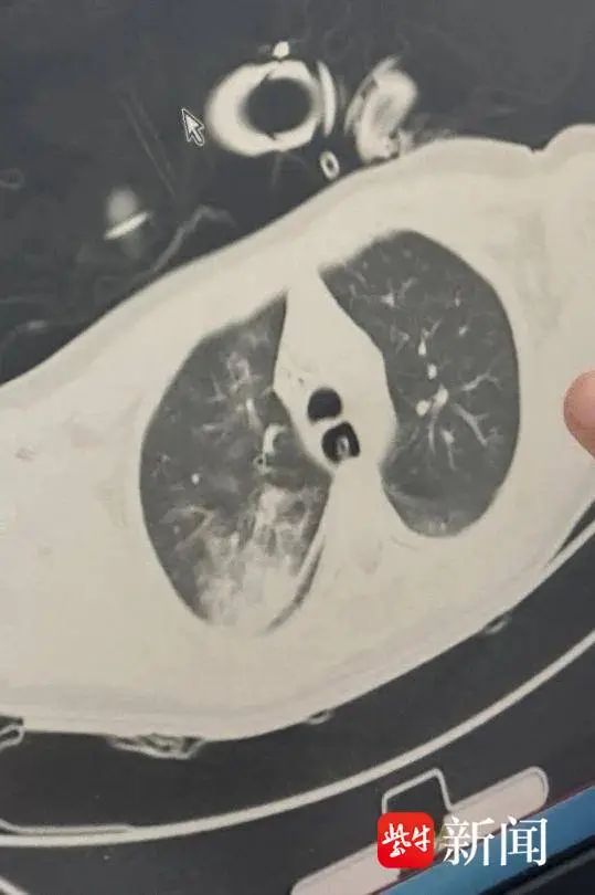 多吃了几口梅干菜，江苏扬州11岁女孩险丧命