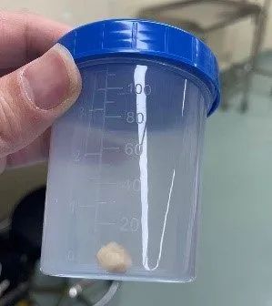 咳咳咳……孩子久咳不愈，不是病毒不是细菌，竟是因为它