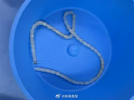 男子将30厘米长串珠塞进尿道拔不出来，连声哀嚎：以后再也不敢