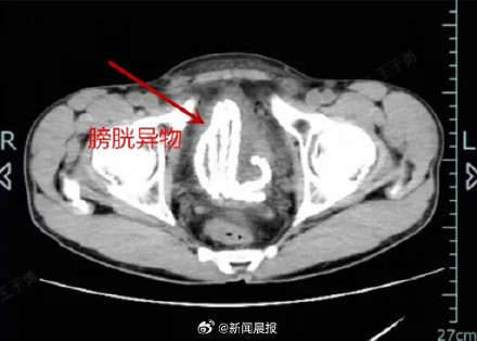 男子将30厘米长串珠塞进尿道拔不出来，连声哀嚎：以后再也不敢
