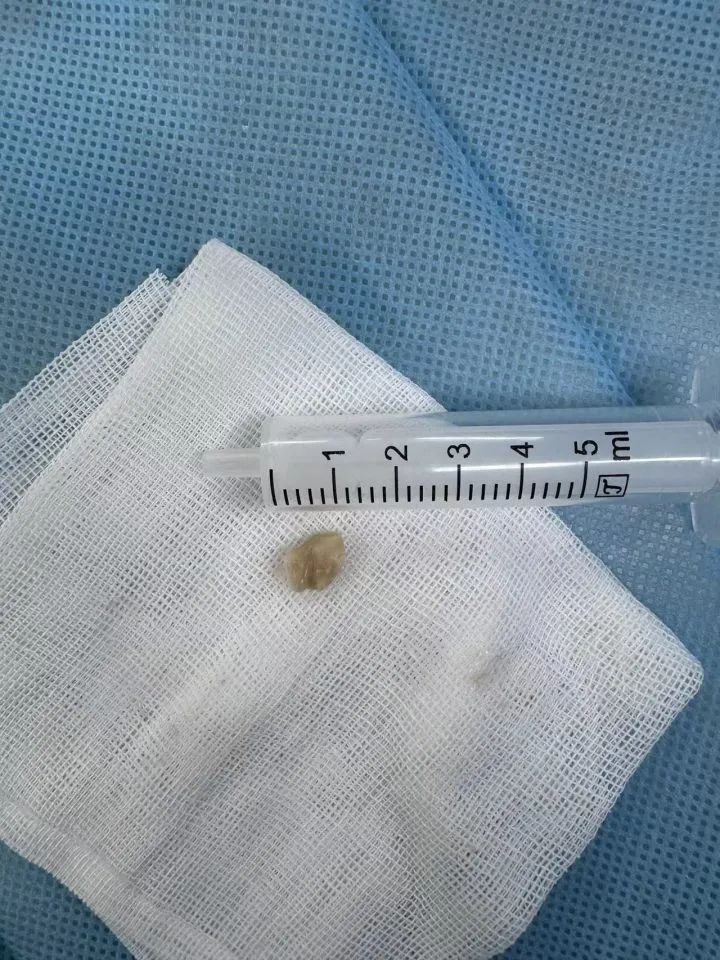 咳咳咳……孩子久咳不愈，不是病毒不是细菌，竟是因为它