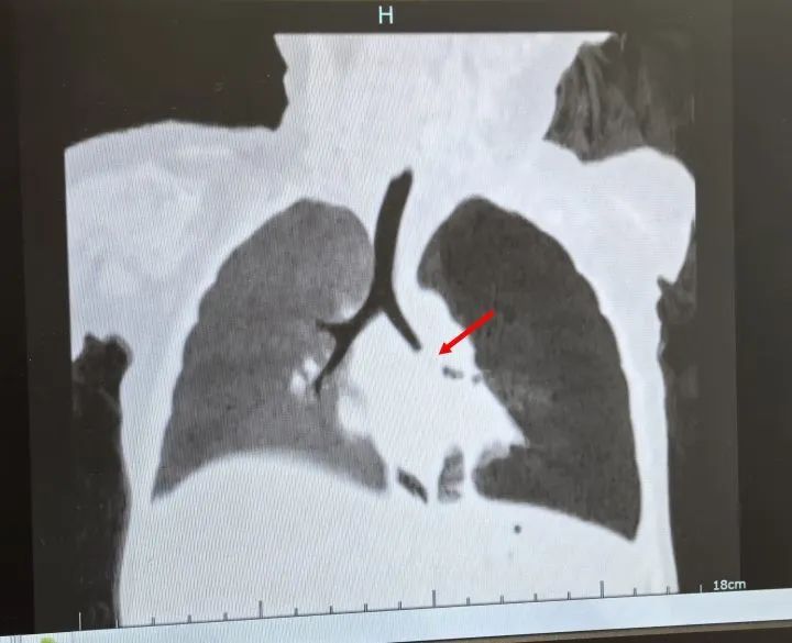 咳咳咳……孩子久咳不愈，不是病毒不是细菌，竟是因为它
