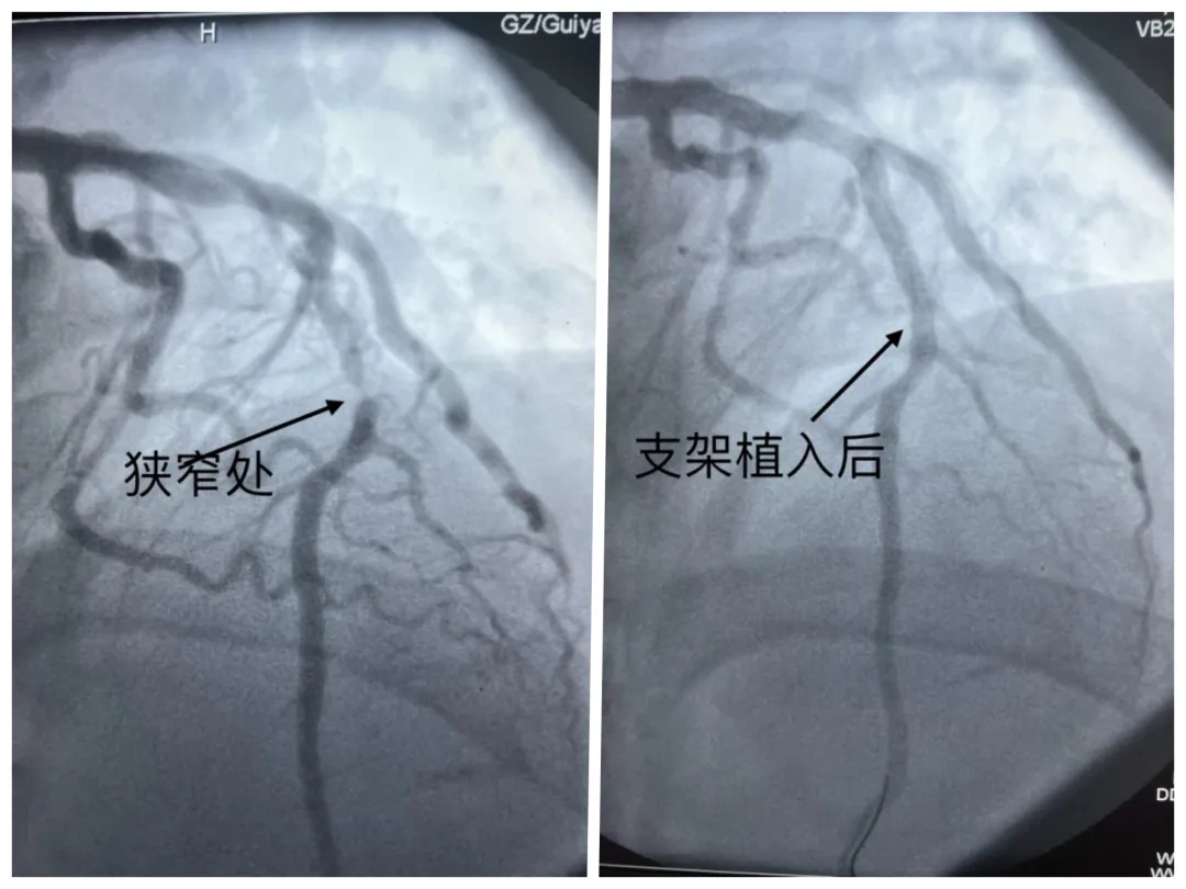 别不当回事！男子牙疼数日，没想到是心肌梗死