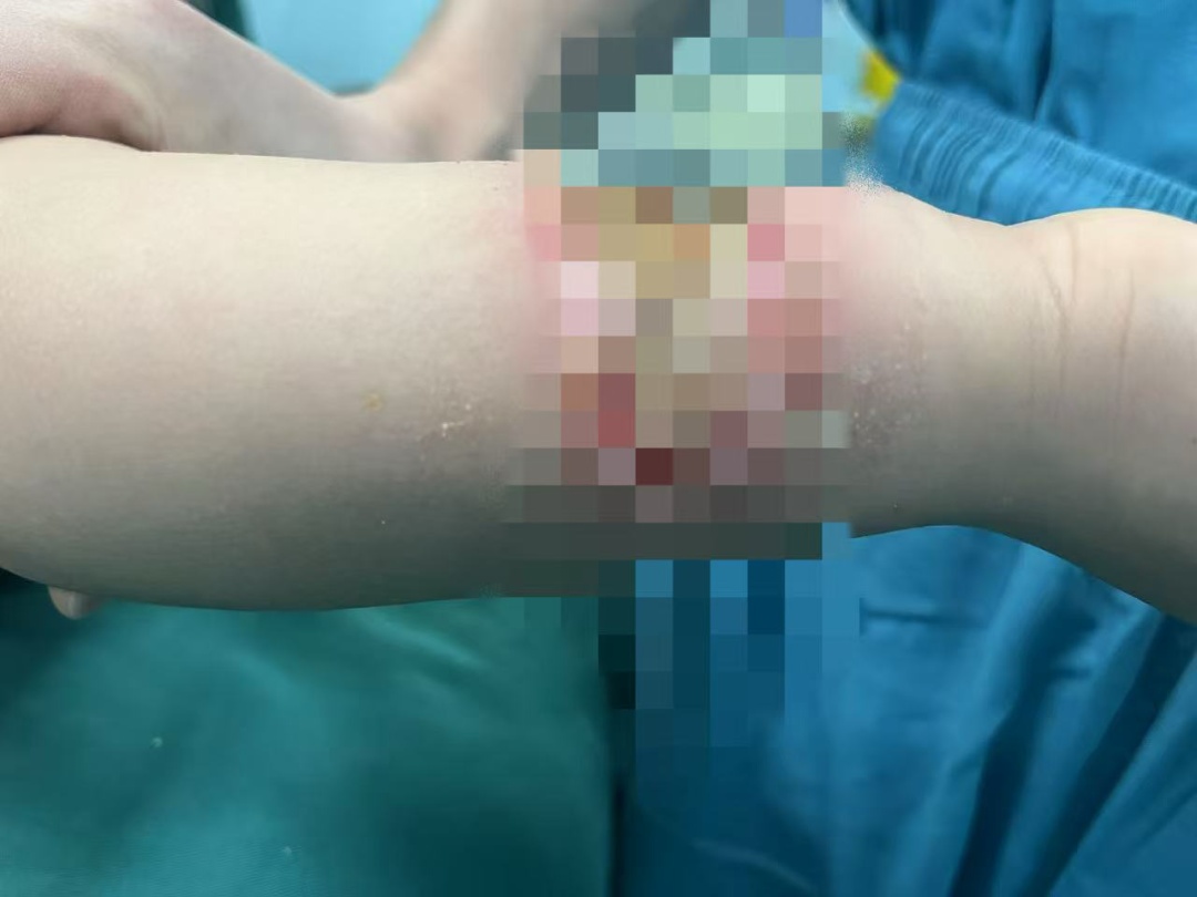 警惕!很多人家中都有,合肥一婴儿被“烧伤” 警惕!很多人家中都有,合肥一婴儿被“烧伤”