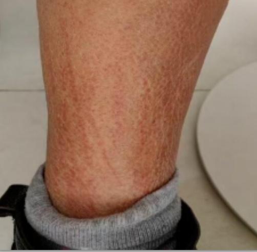 男子一觉醒来身上全是“鞭痕”!医生提醒:务必煮熟→ 男子一觉醒来身上全是“鞭痕”!医生提醒:务必煮熟→