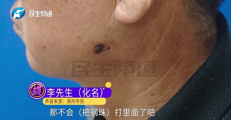 现实版“万磁王”？男子的脸竟能吸住磁铁！一查吓一跳
