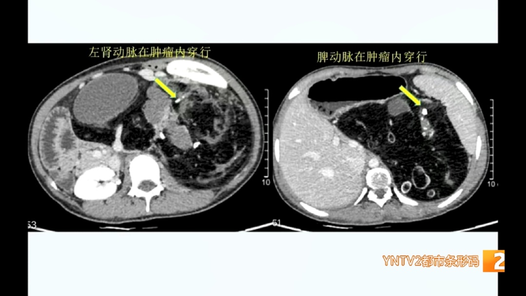 直径超50厘米!约5公斤!女孩腹部巨大肿瘤已相伴20年…… 直径超50厘米!约5公斤!女孩腹部巨大肿瘤已相伴20年……