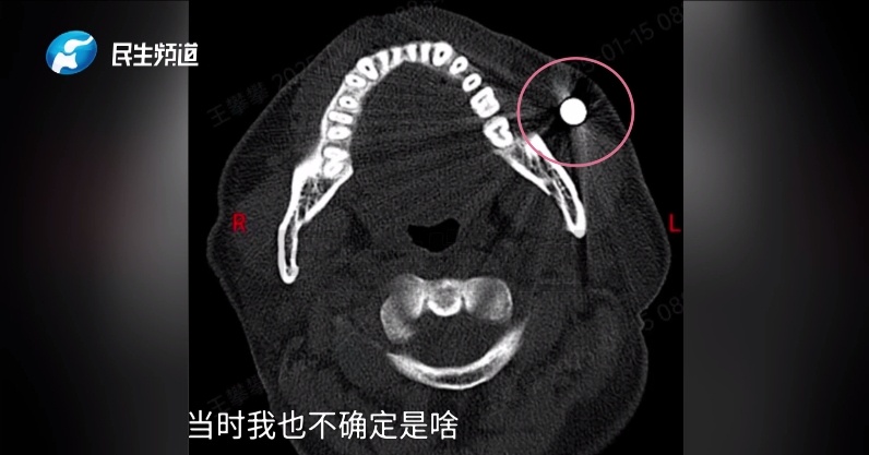 现实版“万磁王”？男子的脸竟能吸住磁铁！一查吓一跳