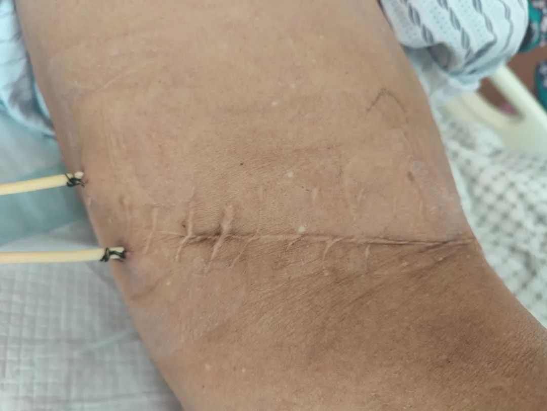 1791颗，密密麻麻！医生都惊呆了：他体内都是这些……