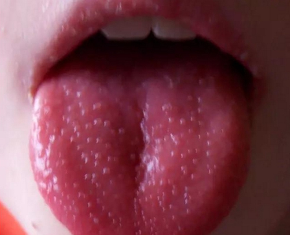 舌头红成草莓色?小心!这可能是传染病的“红色警报”! 舌头红成草莓色?小心!这可能是传染病的“红色警报”!