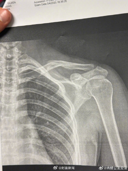 谷爱凌发心碎表情晒X光片 谷爱凌发心碎表情晒X光片