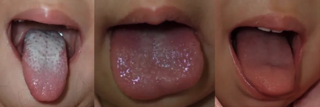 舌头红成草莓色?小心!这可能是传染病的“红色警报”! 舌头红成草莓色?小心!这可能是传染病的“红色警报”!